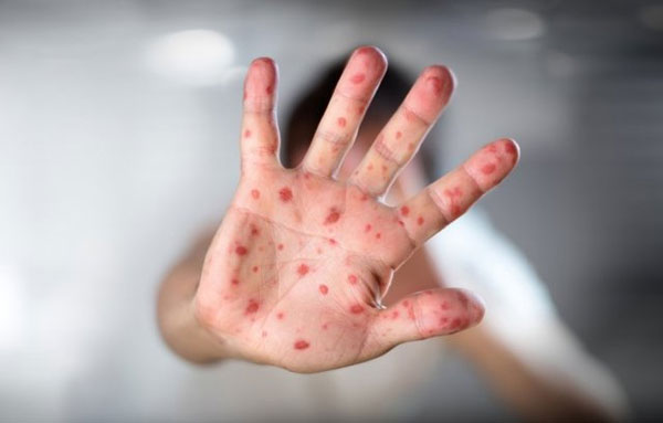 وزارت بهداشت درباره شیوع سرخک هشدار داد